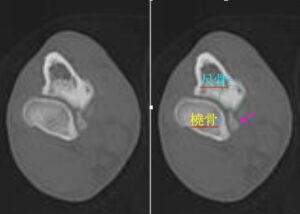 肘関節異形成症に罹患した犬の肘関節のCT断層像。断片化した内側鉤状突起が認められる。松原動物病院 整形外科