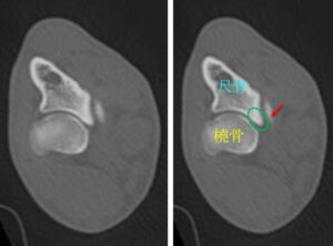 比較のため、正常犬の肘関節のCT断層像。松原動物病院 整形外科