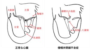 僧帽弁閉鎖不全症の病態図 松原動物病院 循環器科