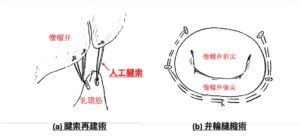 僧帽弁形成術の術式の模式図 松原動物病院 循環器科