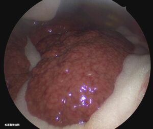 松原動物病院での腹腔鏡下肝生検を実施している様子。肝臓は不整に萎縮し多数の結節が認められ、肝硬変を疑う所見である。