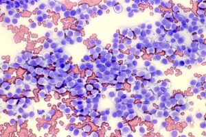 犬の組織球腫で典型的な細胞が採取できたFNAの細胞診。松原動物病院、腫瘍科。