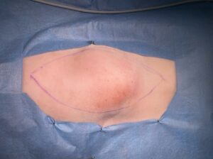 腰部皮下に発生した、皮下〜筋肉の血管肉腫。松原動物病院 腫瘍科