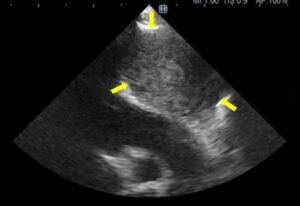 心臓血管肉腫のエコー画像。松原動物病院 腫瘍科