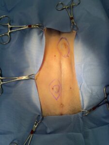 乳腺部付近の皮下腫瘤で、外科摘出後に血管肉腫と診断された症例。松原動物病院 腫瘍科