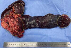 脾臓の血管肉腫。松原動物病院 腫瘍科