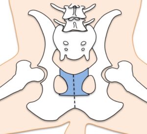 肛門嚢アポクリン腺癌の手術で併用されることがある、骨盤の骨切り。松原動物病院 腫瘍科