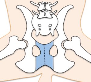 肛門嚢アポクリン腺癌の緩和的手術で実施されることがある、部分的恥骨坐骨切除術。松原動物病院 腫瘍科