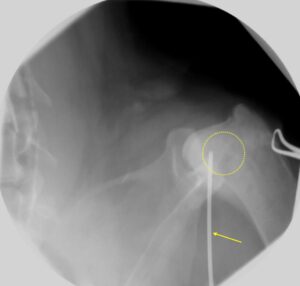 犬の骨肉腫のレントゲン画像。生検を実施している図。松原動物病院　腫瘍科
